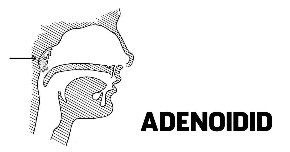 Adenoidid